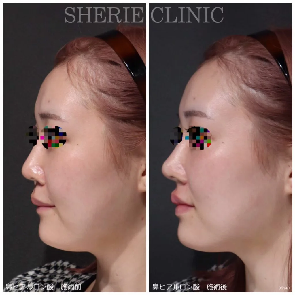 コンビニ鼻皮　プライスダウン年内迄3600円から スキンケアキットおすすめ人気ランキング200選2025年10月1000万人