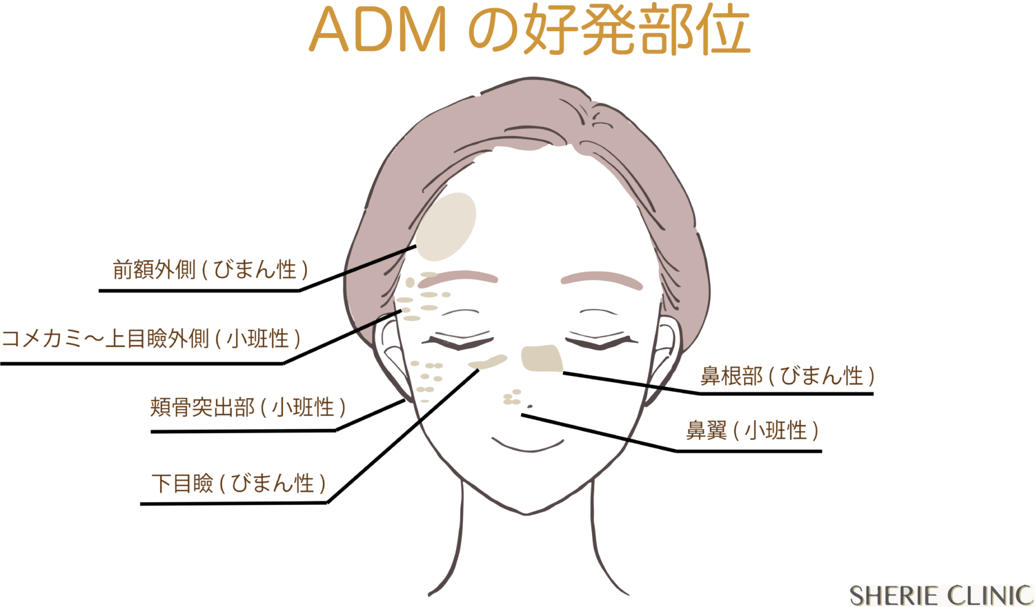 ADMの好発部位ver1.0- 