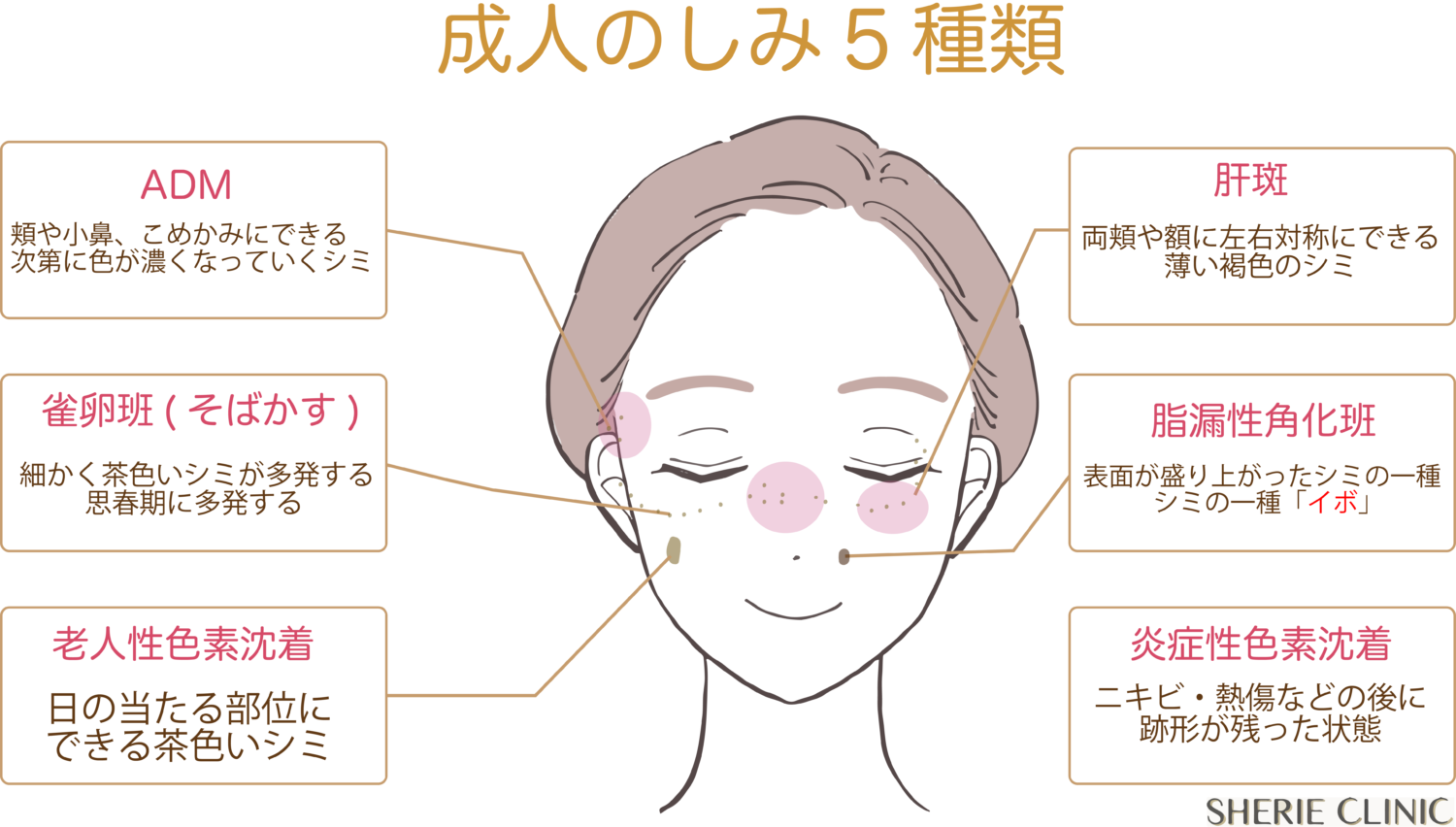 【井上健太郎医師監修】シミ総論 │ シェリークリニック｜コラム総合