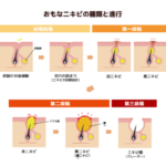 【重症ニキビに終止符】イソトレチノイン治療を「美容クリニック」で受けるべき3つの理由