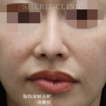 ついに導入！切らない小顔整形の新常識「脂肪溶解注射（カベリン）」