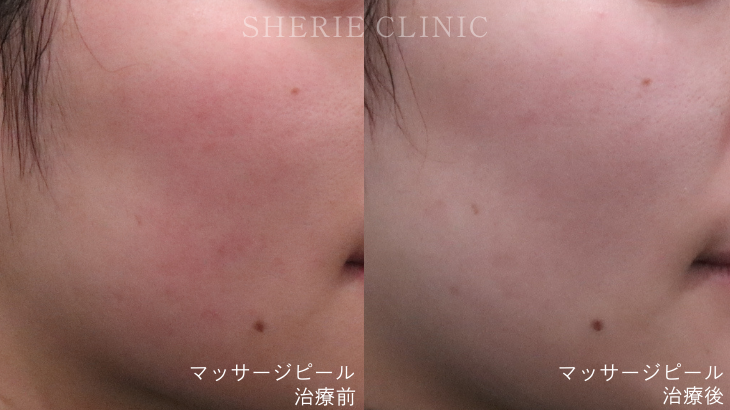 ピーリング剤ってどんな効果があるの？美肌へ導く角質ケア