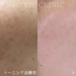 【井上健太郎医師監修】市販レチノールの最大100倍！？「トレチノイン×ハイドロキノン」でシミを追い出す自宅ケア