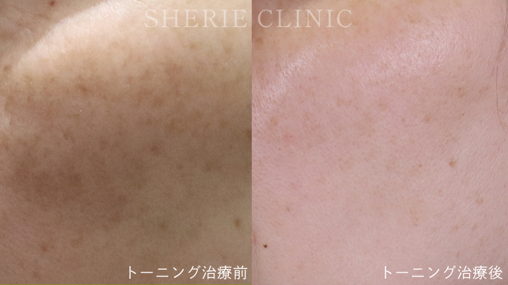 【井上健太郎医師監修】市販レチノールの最大100倍！？「トレチノイン×ハイドロキノン」でシミを追い出す自宅ケア