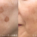 【井上健太郎医師監修】シミは「肌の記憶」最新マシンで挑むシミ攻略法