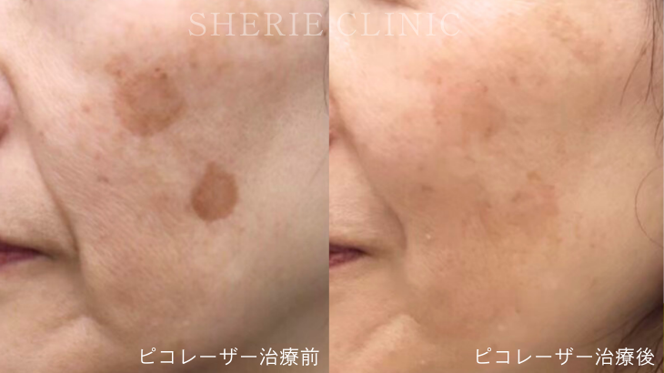 【井上健太郎医師監修】シミは「肌の記憶」最新マシンで挑むシミ攻略法