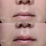 人中短縮ボトックスについて