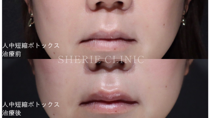 人中短縮ボトックスについて