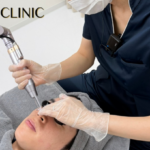 【井上健太郎医師監修】毛穴・クレーター治療の味方！ピコフラクショナル