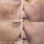 肝斑（かんぱん）がある人でも受けられる治療って？