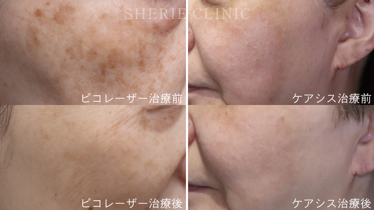 肝斑（かんぱん）がある人でも受けられる治療って？