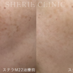 【井上健太郎医師監修】ステラM22が「向いている人」は？