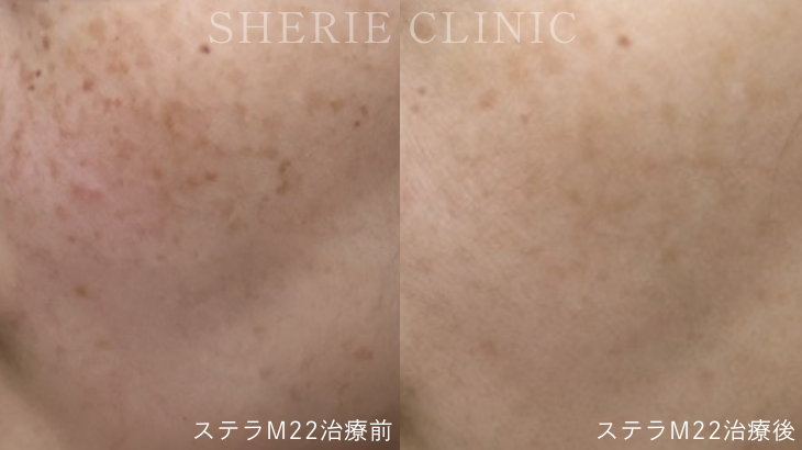 【井上健太郎医師監修】ステラM22が「向いている人」は？