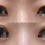 【井上健太郎医師監修】眉下切開で作る、周りにバレない大人の若見え目元