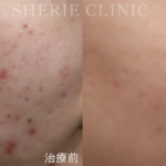 【井上健太郎医師監修】ニキビ治療の切り札。自費診療だからできること