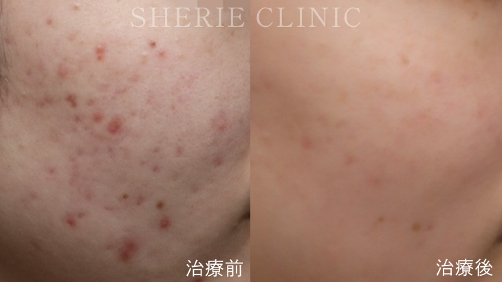 【井上健太郎医師監修】ニキビ治療の切り札。自費診療だからできること