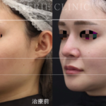 輪郭3点手術とは？
