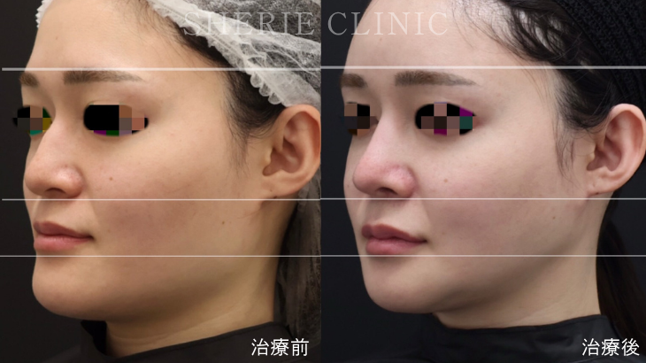 輪郭3点手術とは？