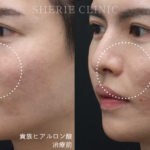 貴族フィラーで若返り💉