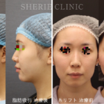 輪郭をデザイン！脂肪吸引・糸リフトを徹底比較