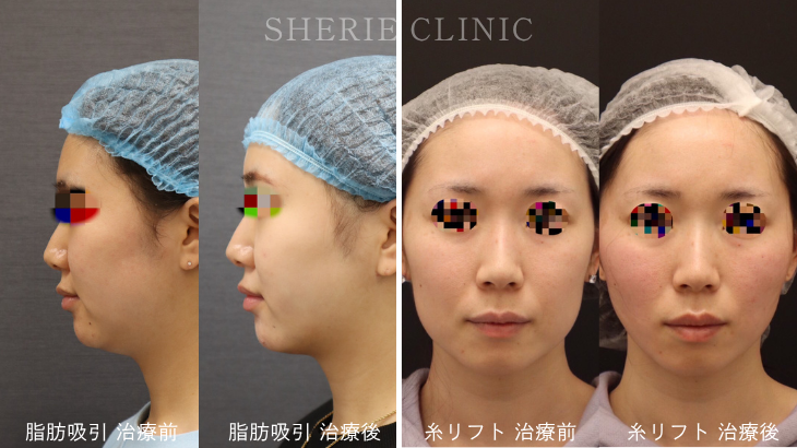 輪郭をデザイン！脂肪吸引・糸リフトを徹底比較