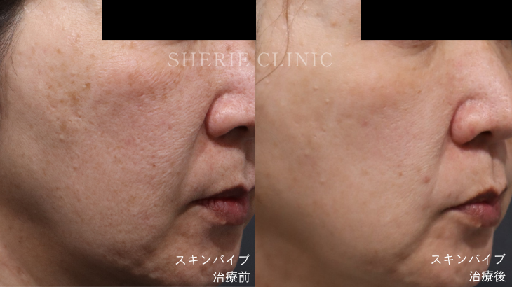 【全国トップクラスの消費量】シェリーのスキンバイブがいい理由