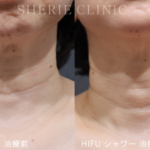 年齢は「首元」に出る？首のたるみ・シワの改善方法