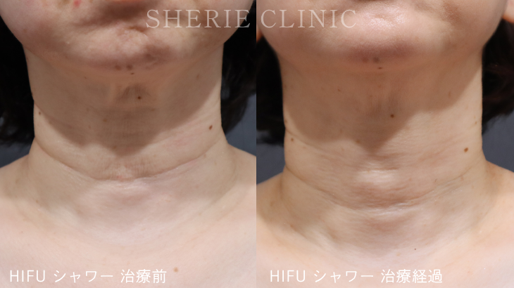 年齢は「首元」に出る？首のたるみ・シワの改善方法