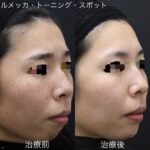 シミ取りカウンセリングで必ず聞くべきこと｜後悔しないためのポイントを解説