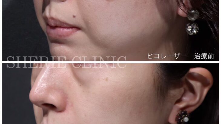 ピコスポット後にシミが濃くなった？「戻りジミ」の原因と今からできる対策