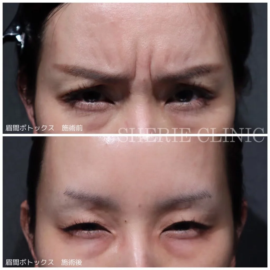 老けた雰囲気を与えてしまう「眉間のシワ」 原因と解消方法は? │ シェリークリニック|しわ・ほうれい線に関するコラム