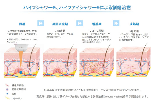 ハリを出したい時は「ハイフシャワー」