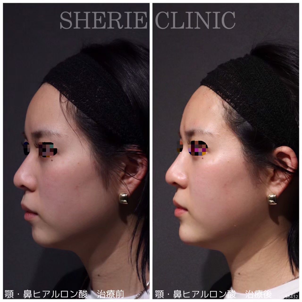 ヒアルロン酸（鼻・顎） - シェリークリニック