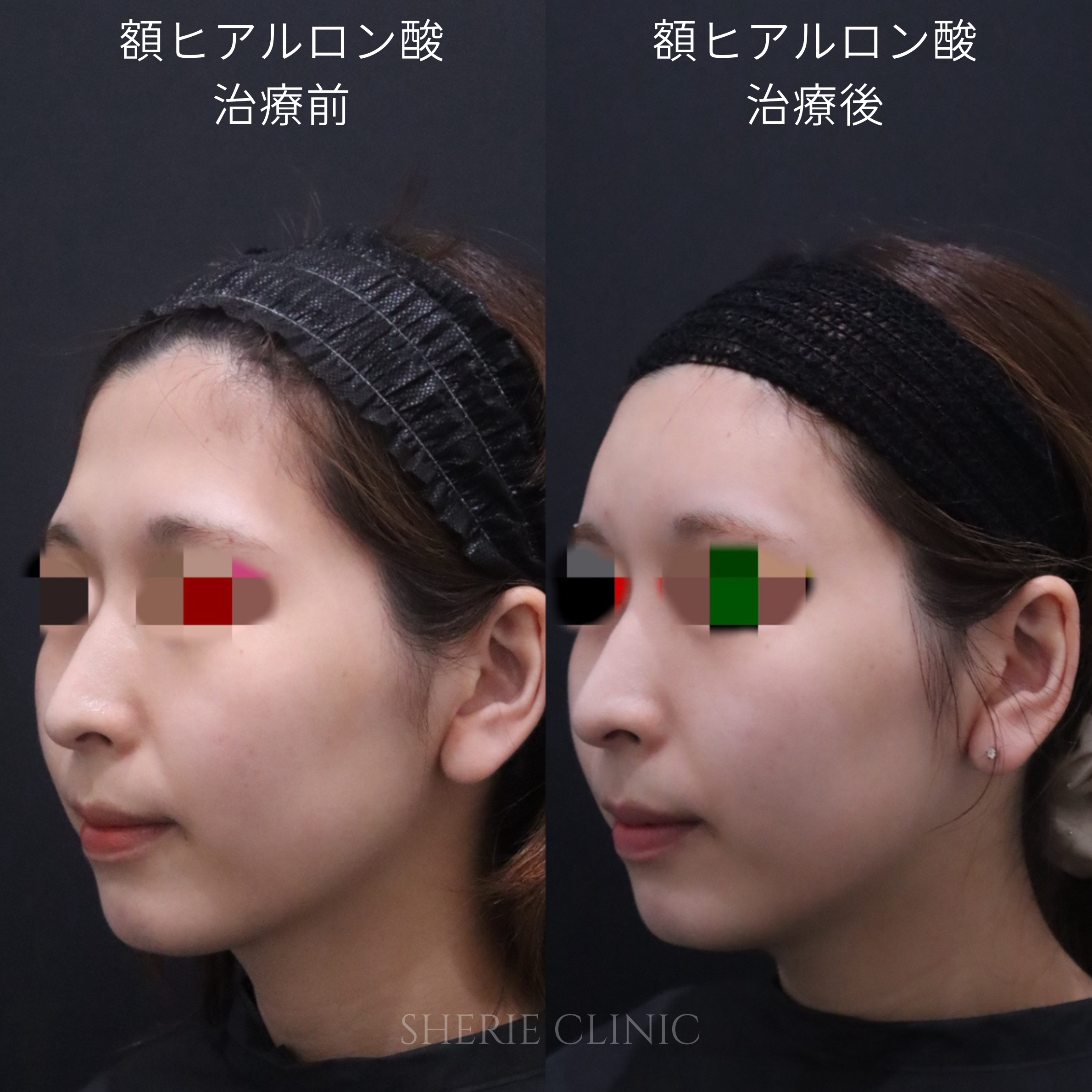 ヒアルロン酸（額） 