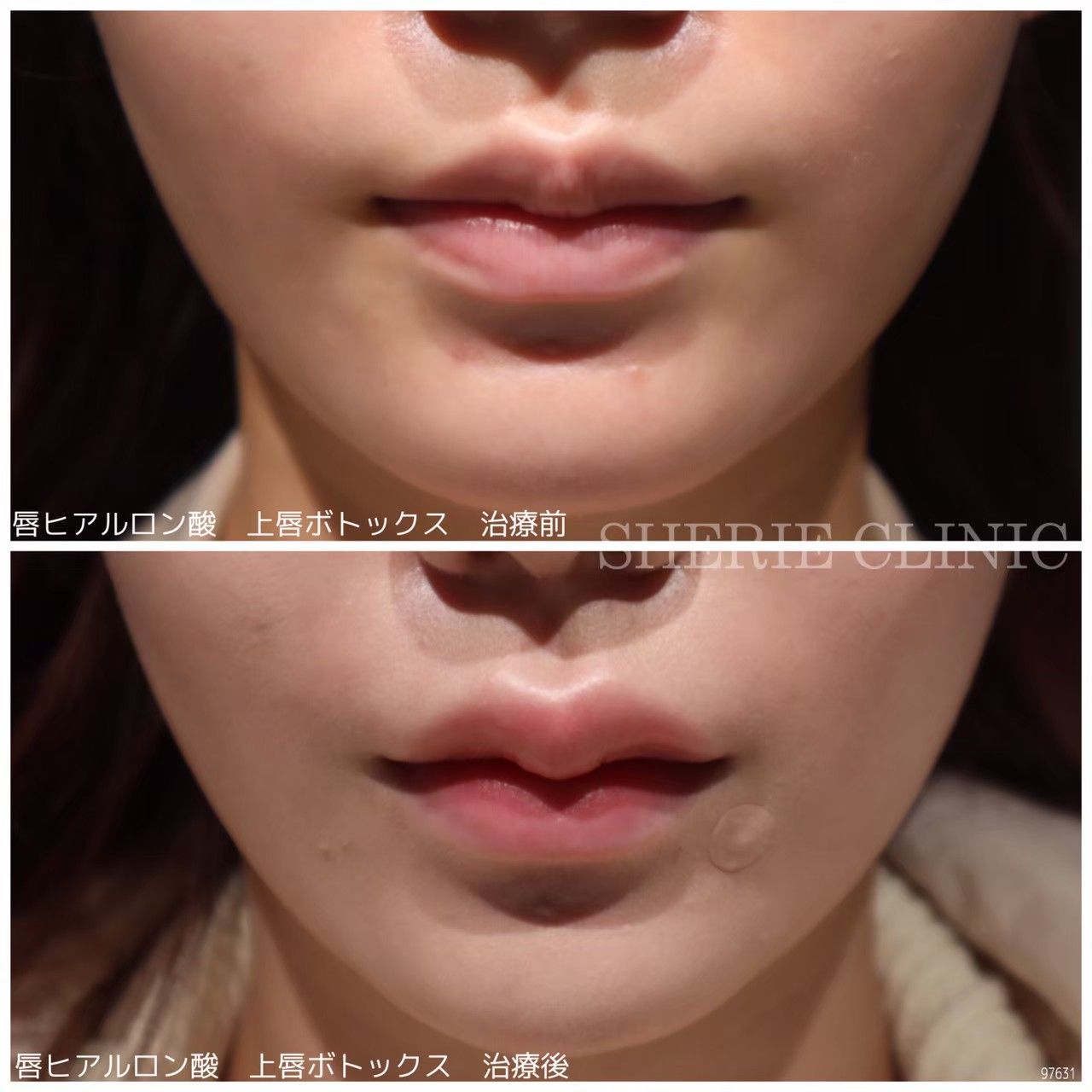 ヒアルロン酸 26eee29b2b4b09034cd2e34aa5a4d1