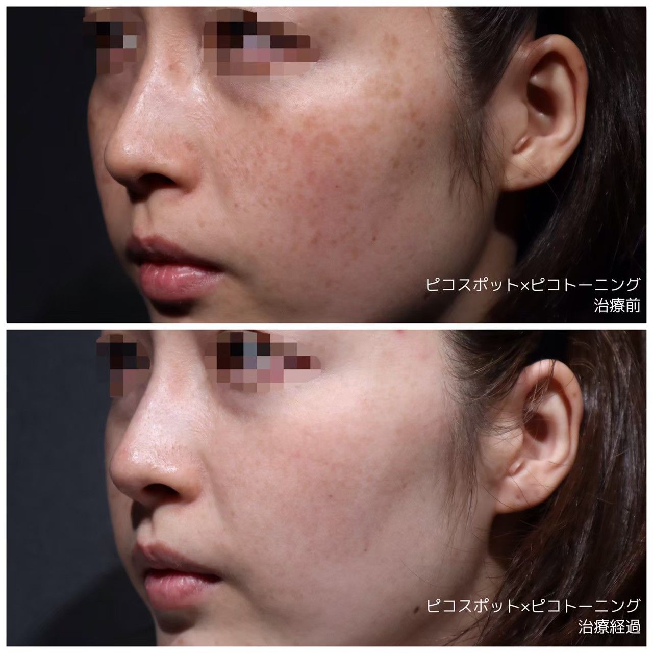 シミ？そばかす？ 何が違うの？？ - シェリークリニック