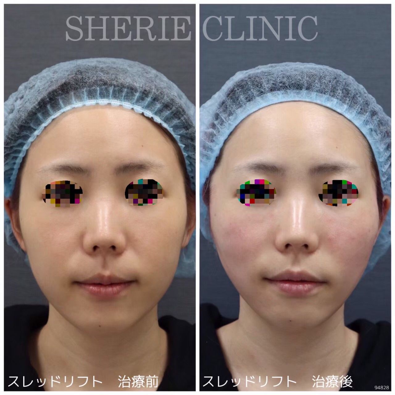 スレッドリフト - シェリークリニック