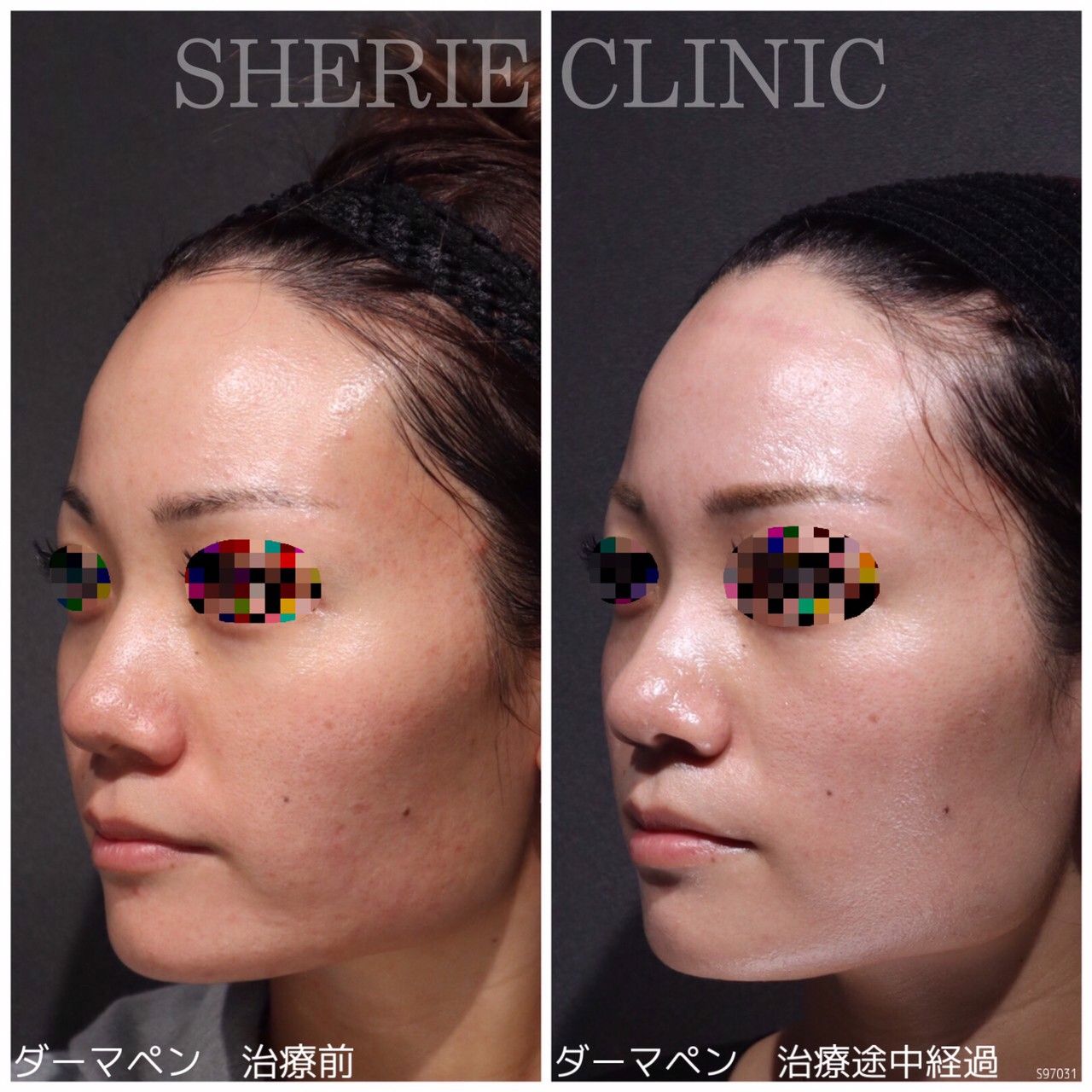 ダーマペン 4470d026a65e1e5847ef07f146dedb