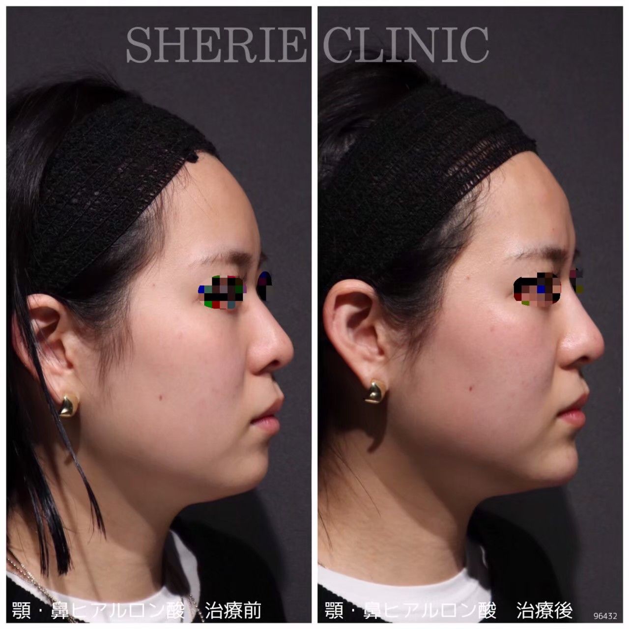 ヒアルロン酸（鼻・顎） - シェリークリニック