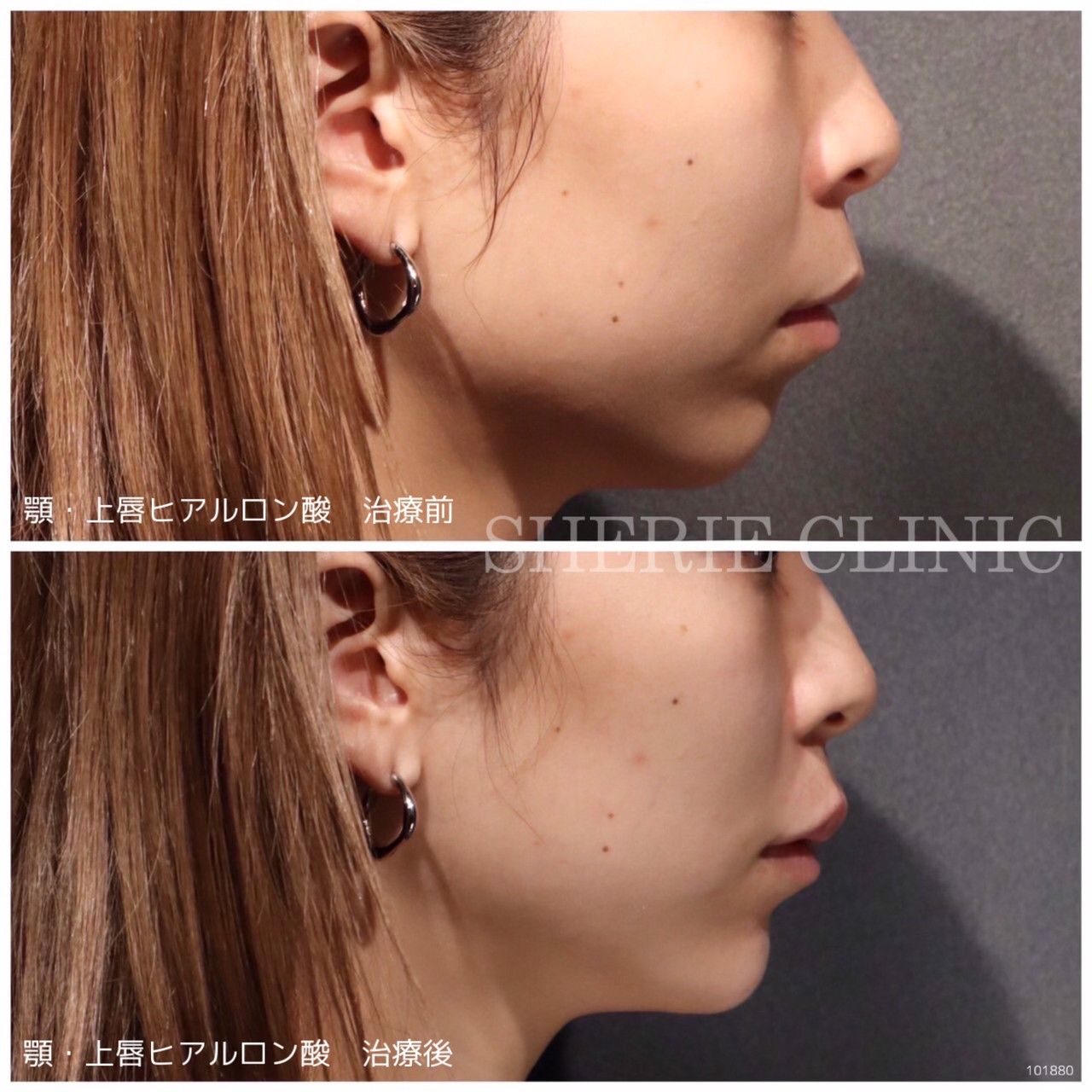 ヒアルロン酸（顎・唇） - シェリークリニック