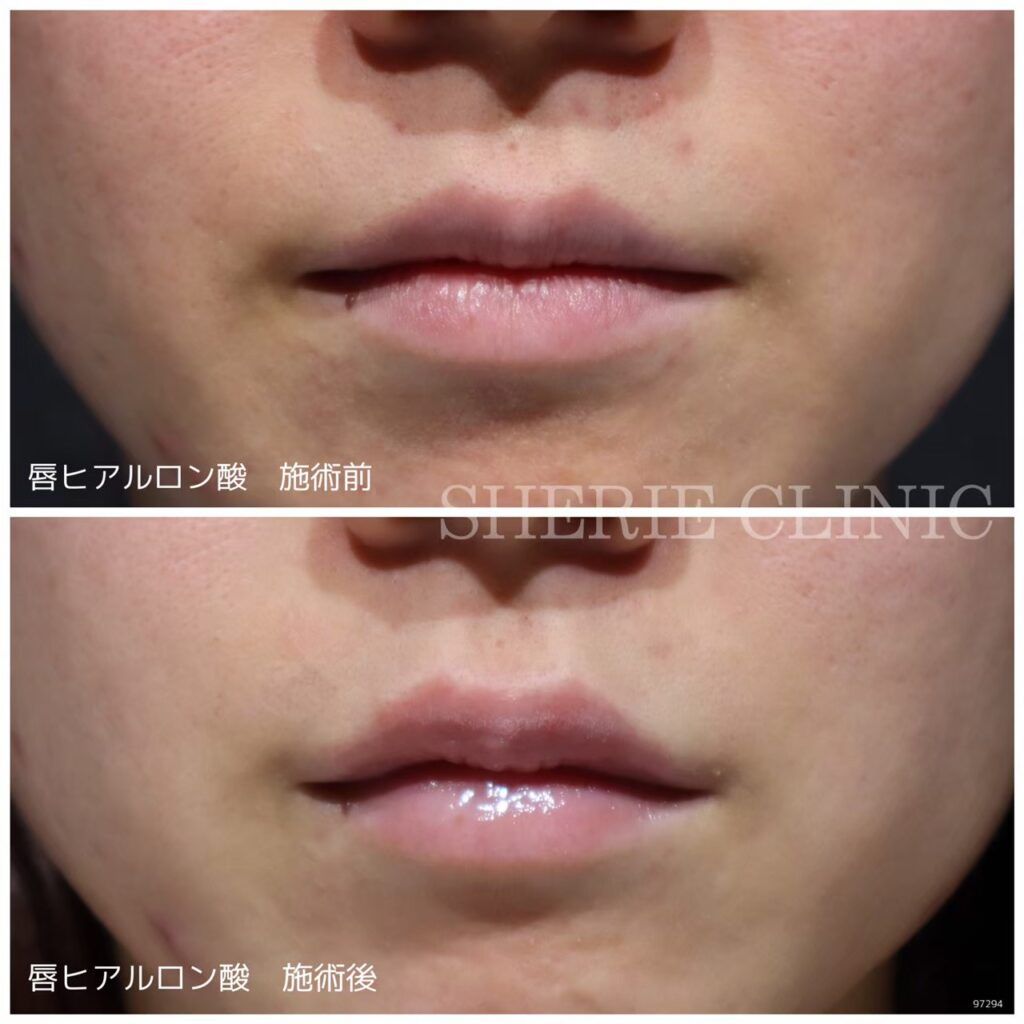 LIPS！唇の形！ Mカラー SI2/0.334ct/RT0382/CGL | www.causus.be