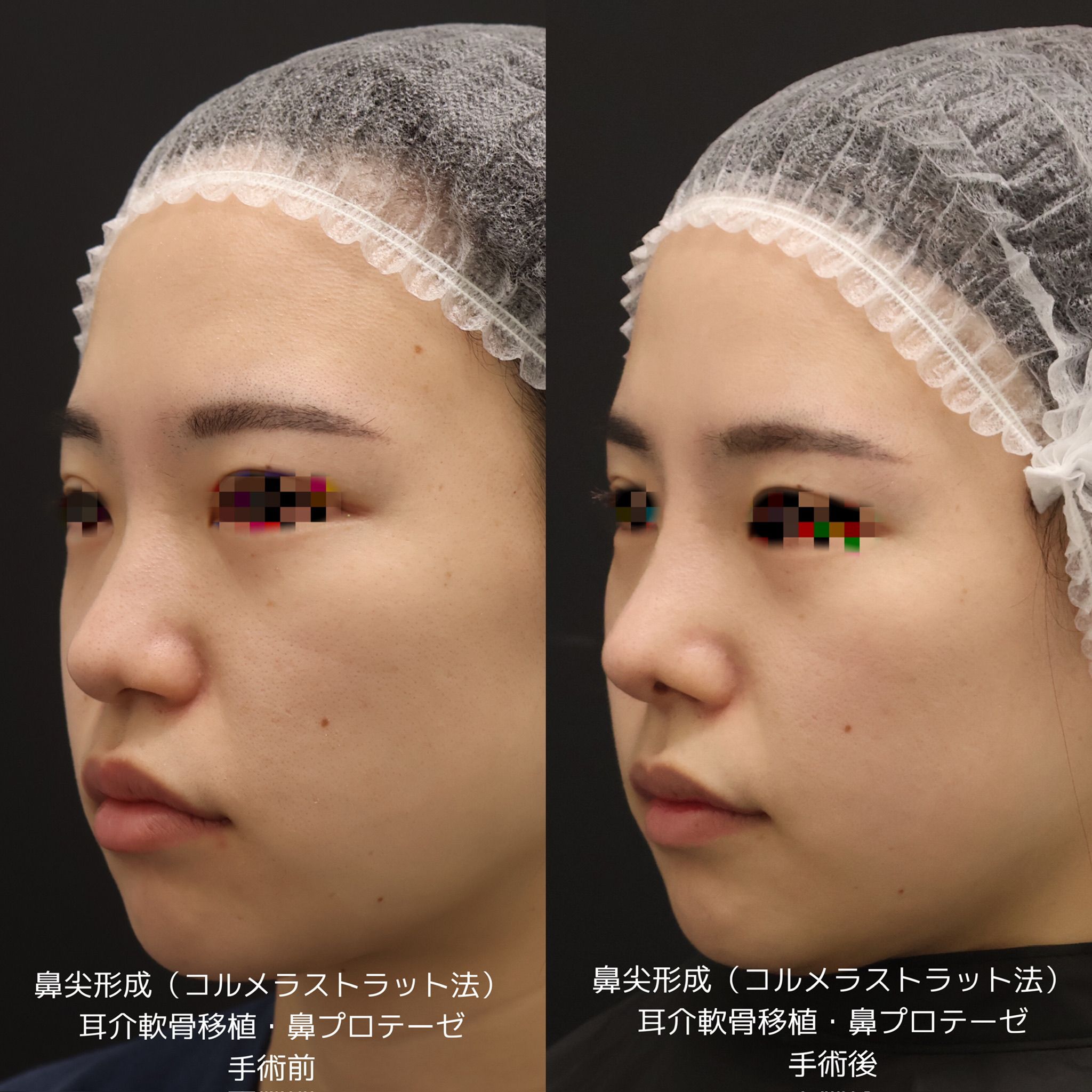 最高峰の鼻整形 – 鼻整形のスペシャリストが施術 - シェリークリニック