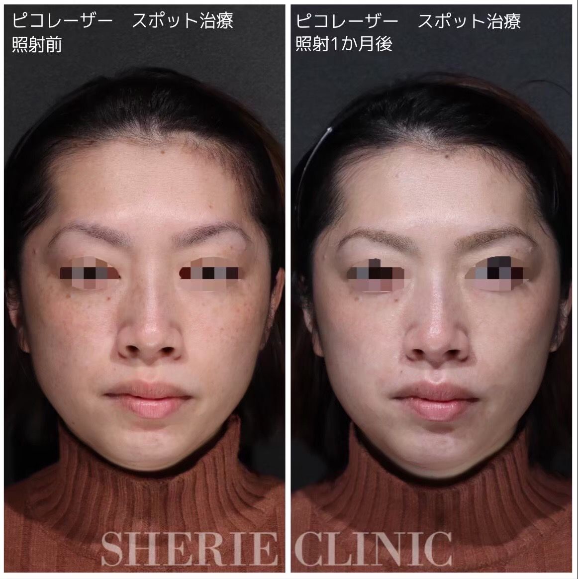 ピコスポット（シミ取り放題） - シェリークリニック