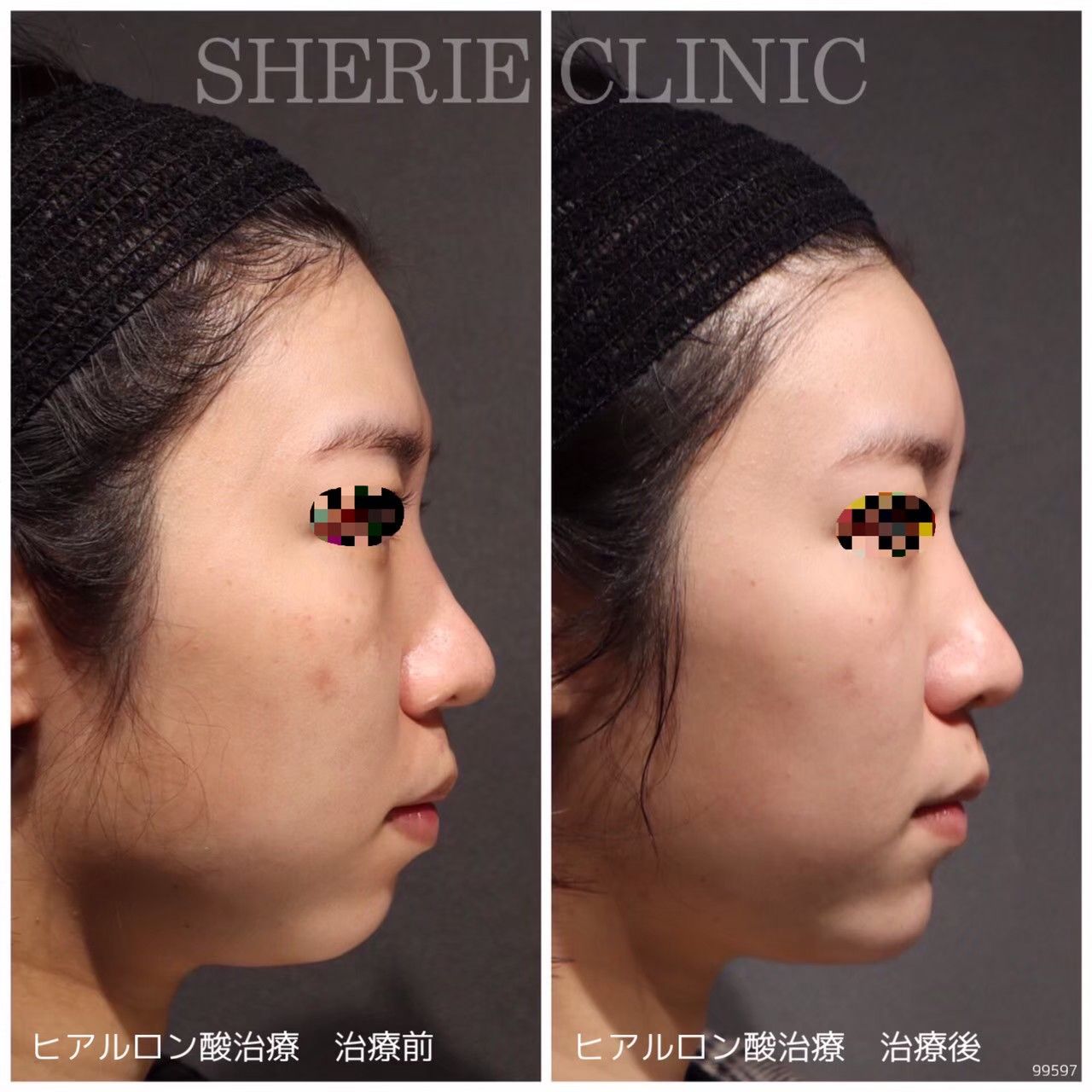 ヒアルロン酸（額・顎） - シェリークリニック