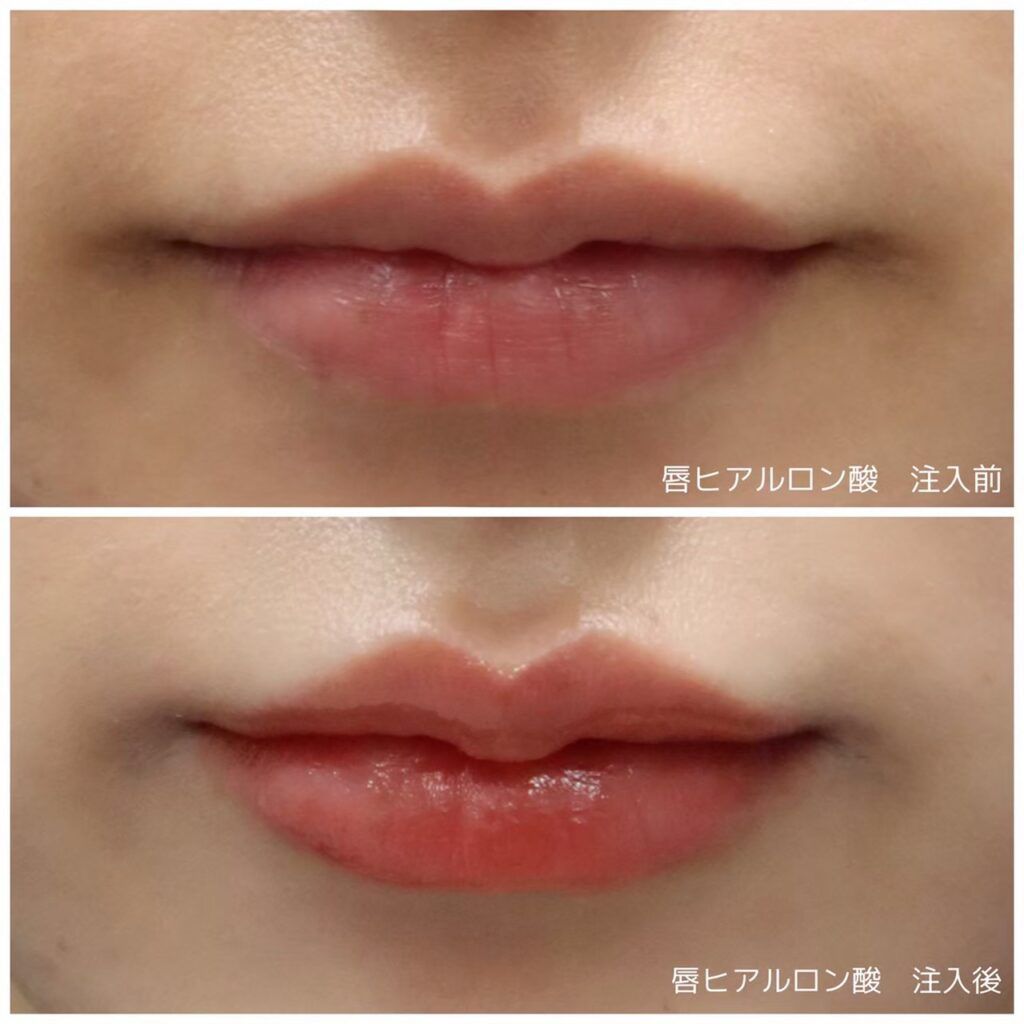 好みの唇の形は M字 スマイルリップ Cカール 人気の唇を徹底調査 シェリークリニック 本院