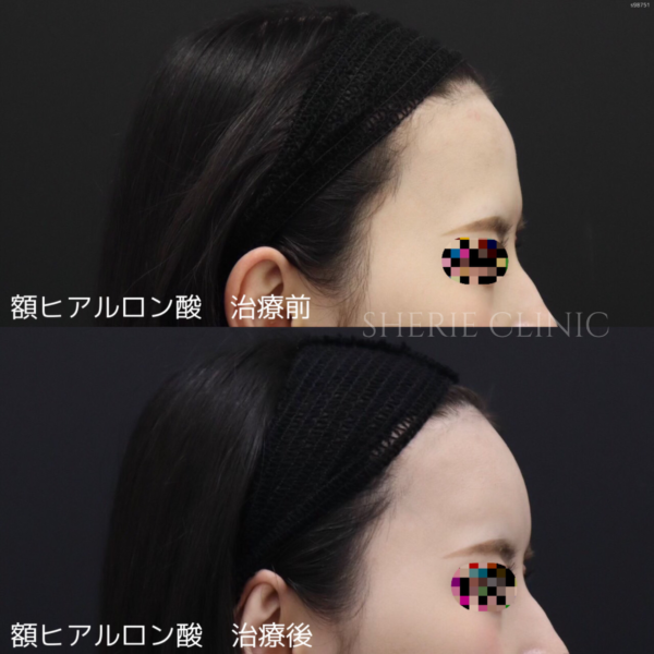 ヒアルロン酸（額） 