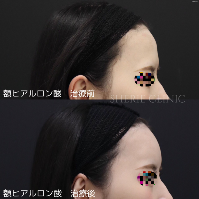 ヒアルロン酸（額）