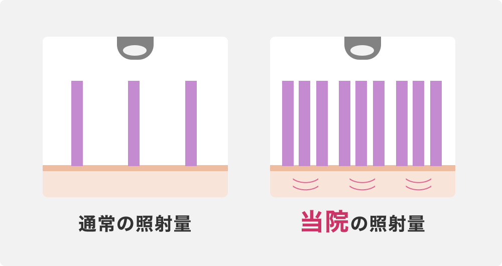 当院は通常の2~3倍のレーザー照射