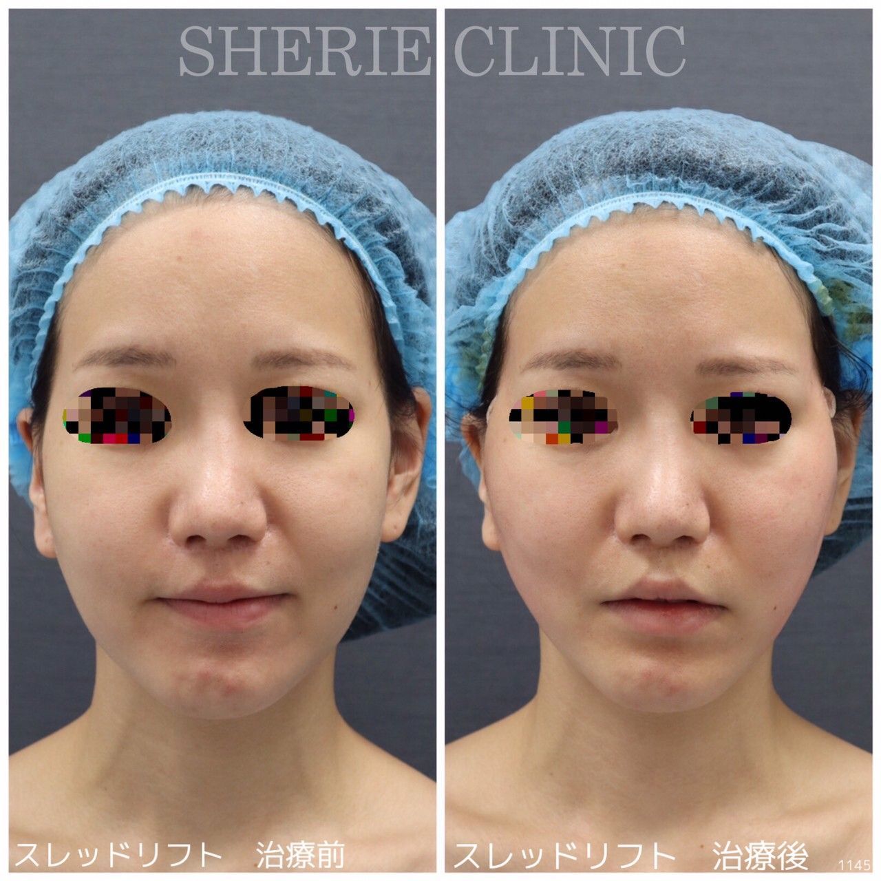 スレッドリフト - シェリークリニック